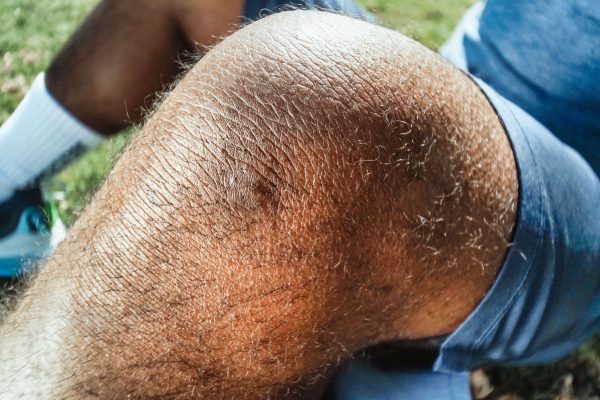 Gros plan détaillé d'un genou blessé avec un bleu, capturé en extérieur à la lumière naturelle.